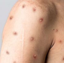 Cómo saber si es viruela del mono u otra enfermedad con síntomas similares en la piel