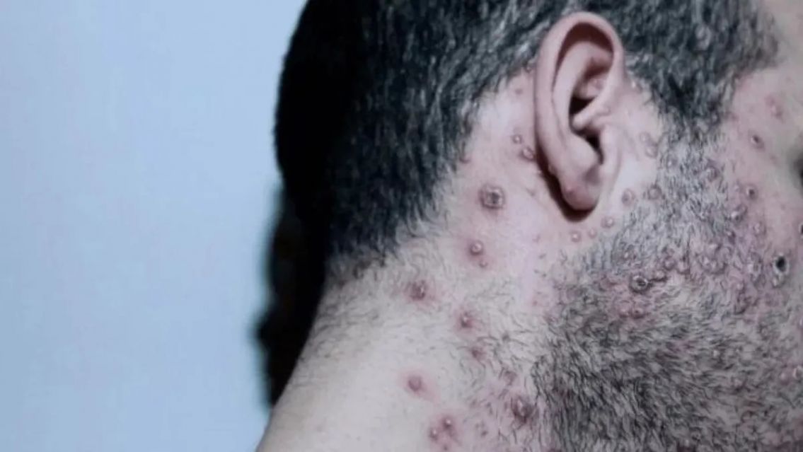 Alerta: viruela del mono muy cerca de Jujuy