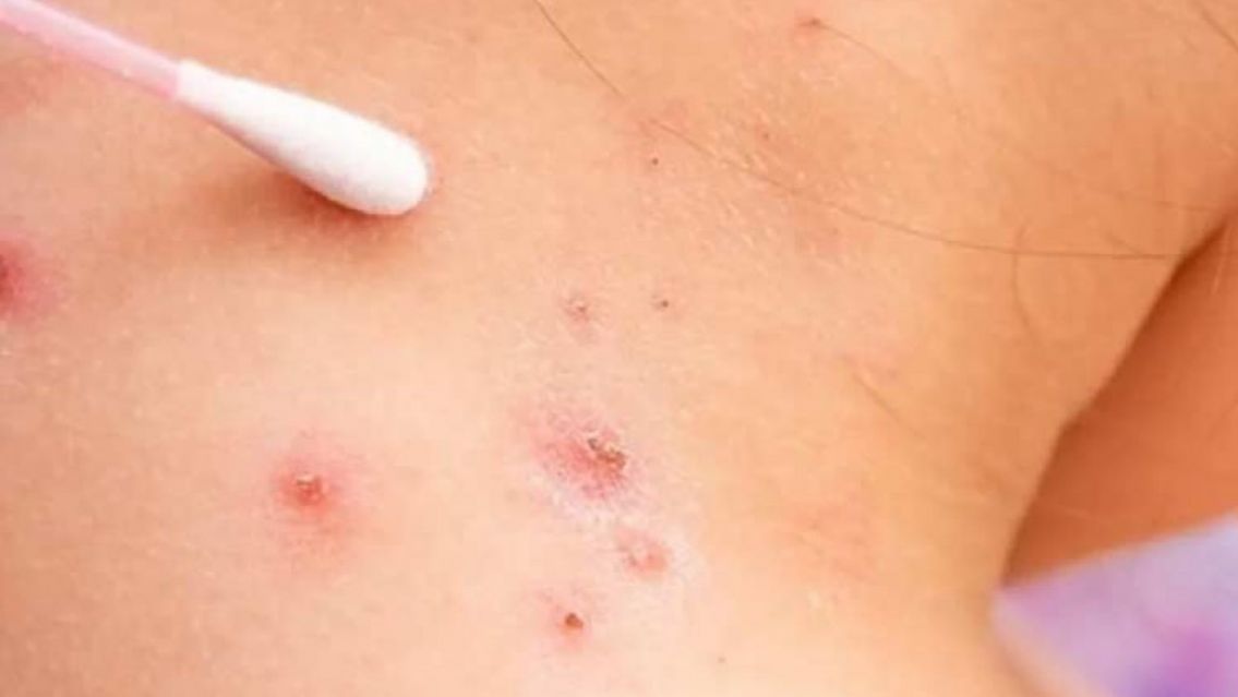 Apareci� el primer caso sospechoso de viruela del mono cerca de Jujuy