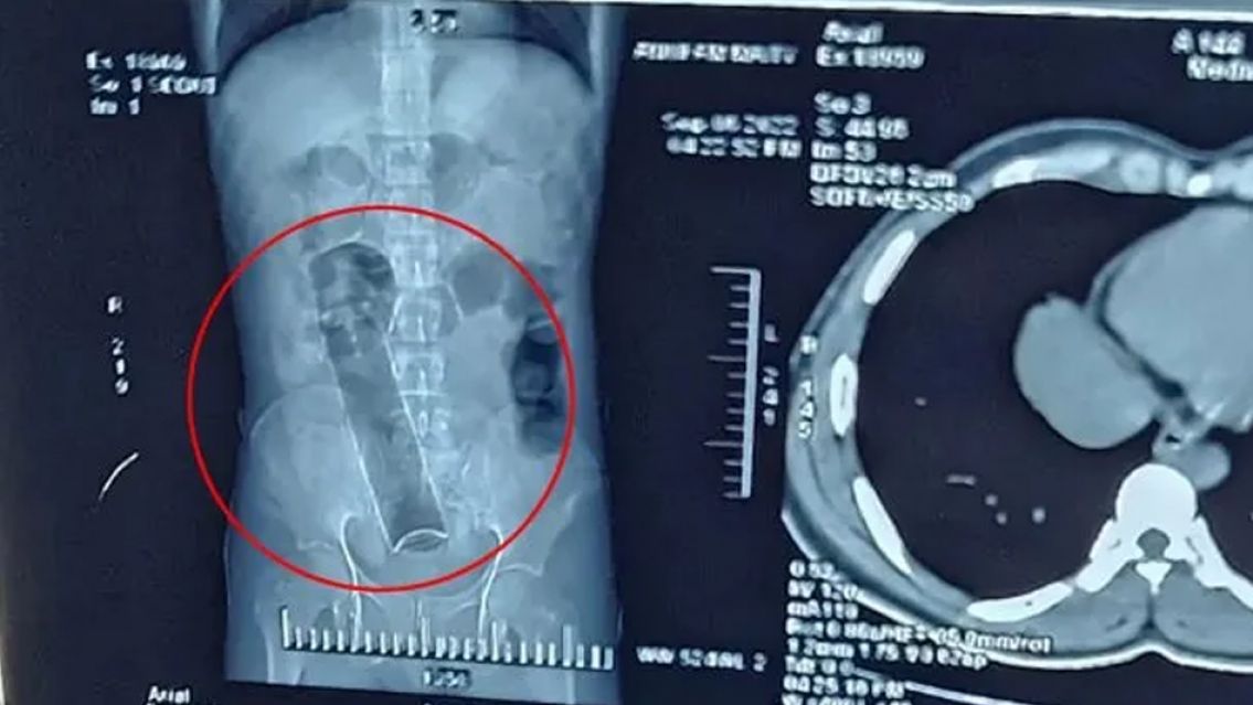 Terminó con un desodorante en el ano y tuvieron que operarlo de urgencia: medía más de 15 centímetros