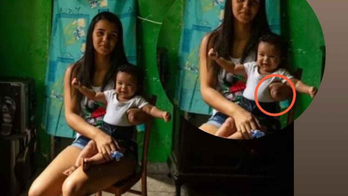 Estaba embarazada, fue a dar a luz y volvió sin una mano. Denuncia mala praxis