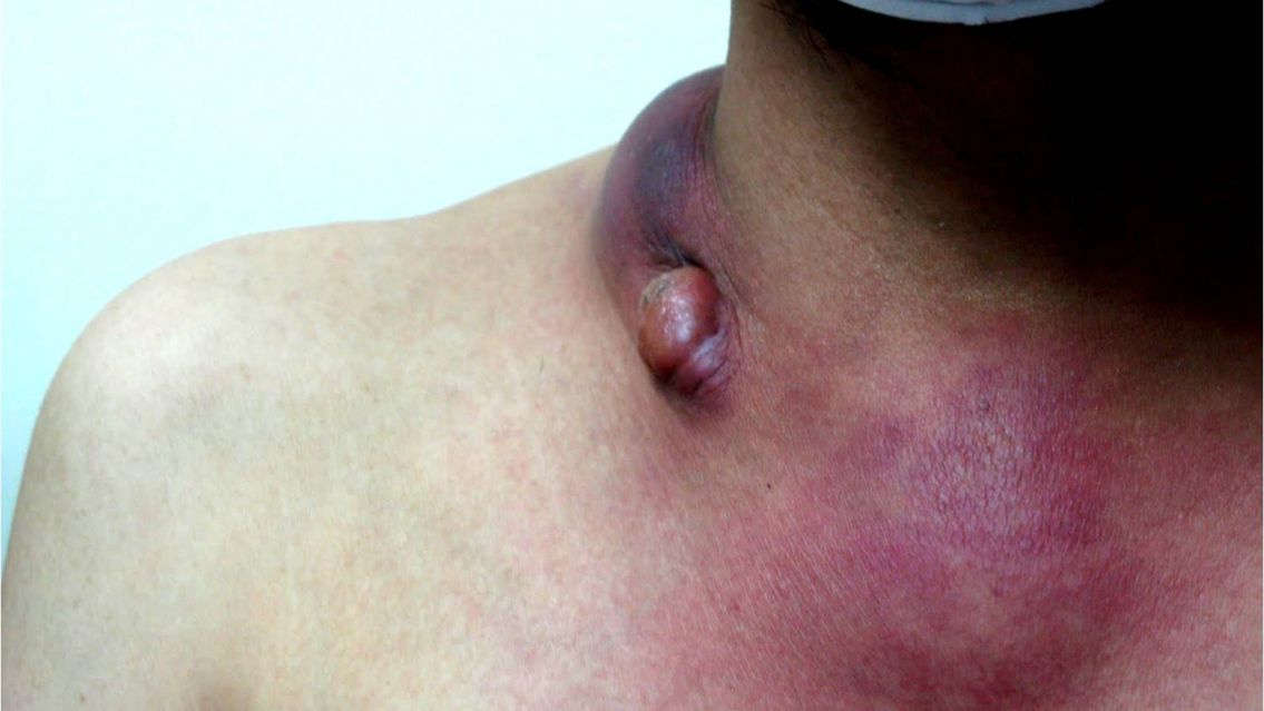 Otra enfermedad que se tornó mortal en Jujuy y es más común de lo que creías