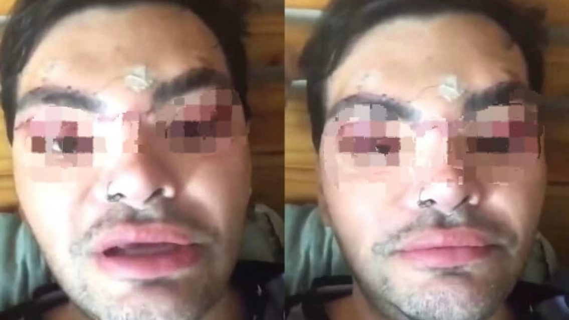 Ser el "clon" de Ricky Martin, sale mal. As� qued� Fran Mariano luego de sus operaciones