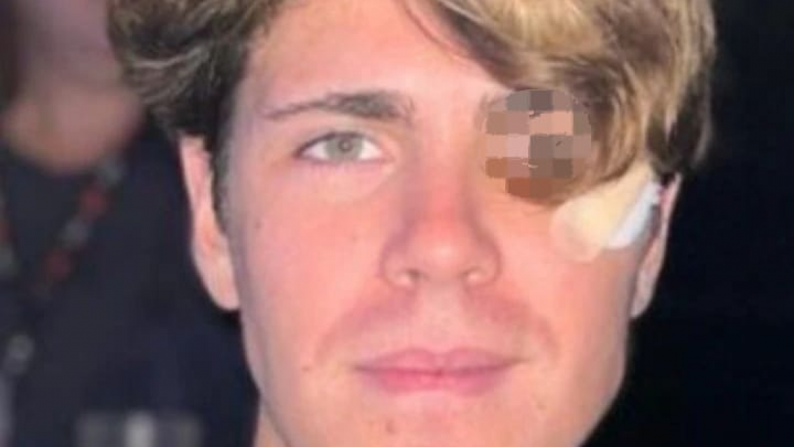 ¡Un moretón así de grande! Mostraron cómo tiene el ojo Marcos Ginocchio