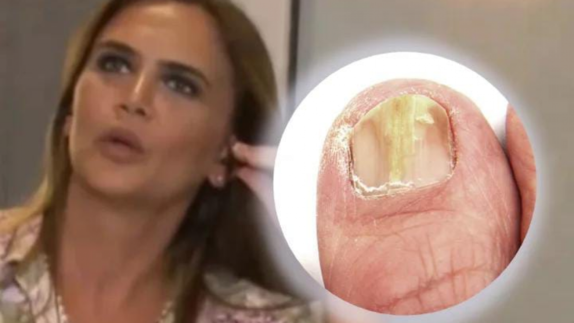 El problema de Amalia Granata en los pies. No puede caminar bien...