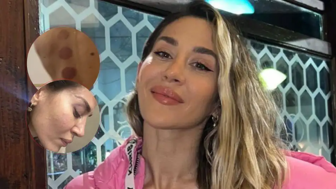 Jimena Bar�n preocup� a sus fans, mostr� marcas en la piel y pidi� ayuda