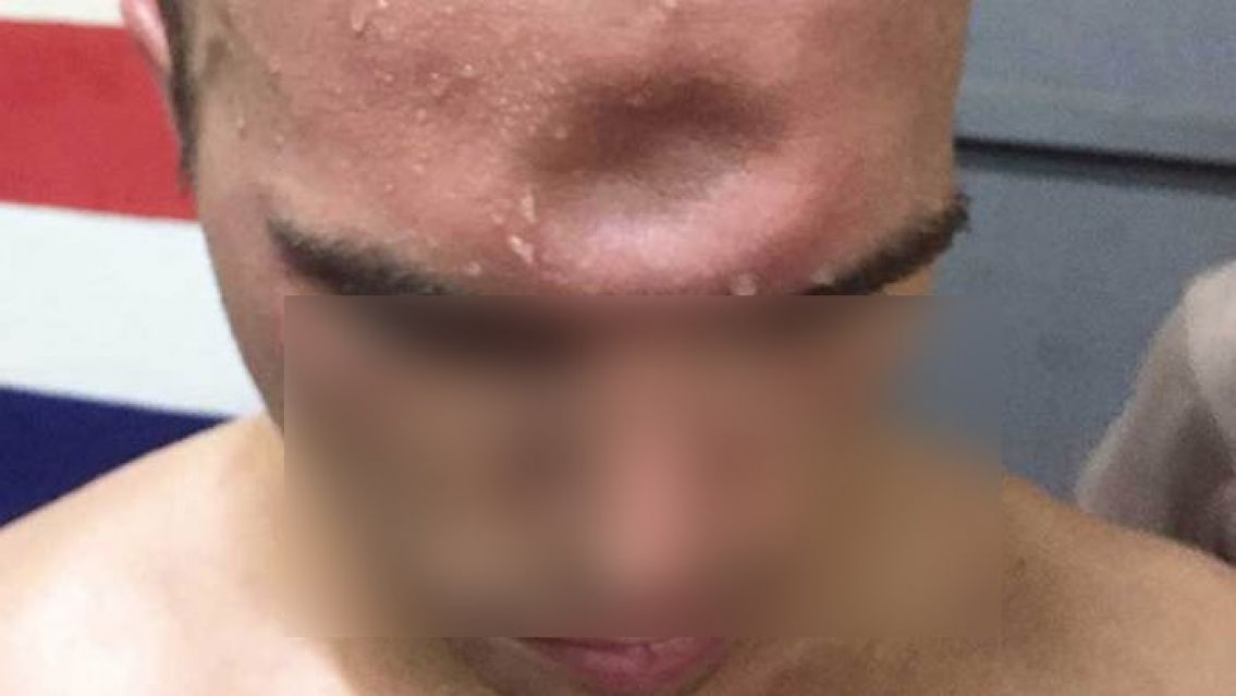 Jujeños tomaron de más y uno le partió la cabeza al otro: no lo denunció