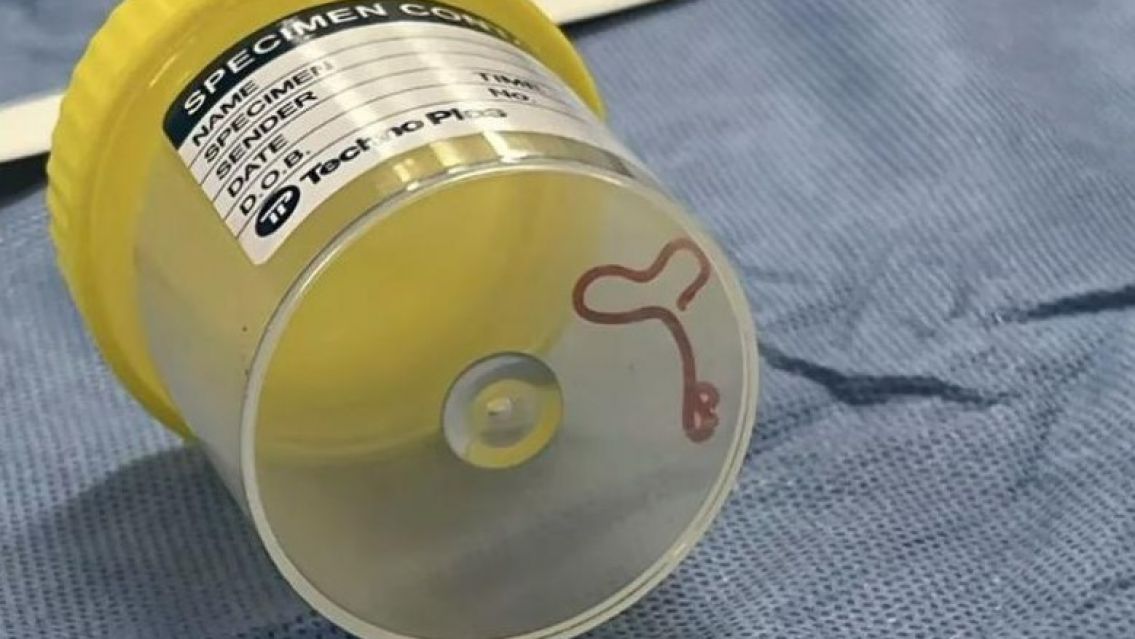 Le hallaron un gusano vivo en el cerebro y un detalle caus� espanto